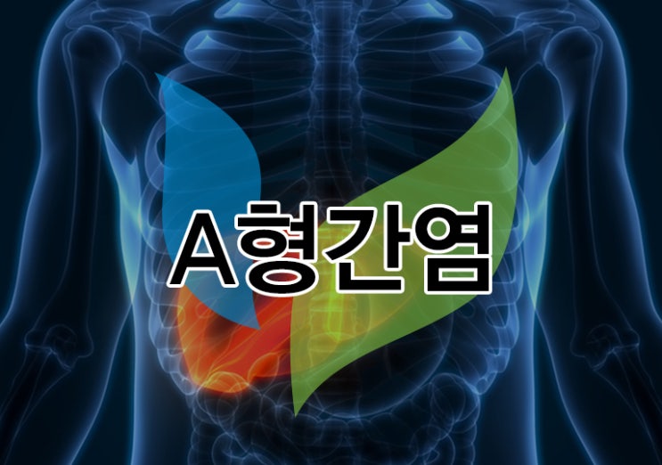  A형 간염/ 감기와 비슷한 증상, 면역력이 없는 20~40대 주의!