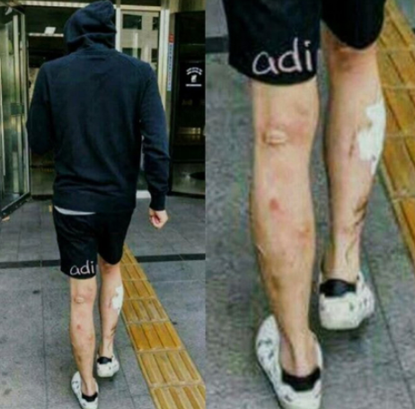 박유천약물부작용 다리와 손의상처 "부작용15가지"