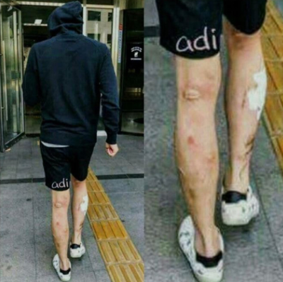  박유천 다리 상처 필로폰 메스버그현상