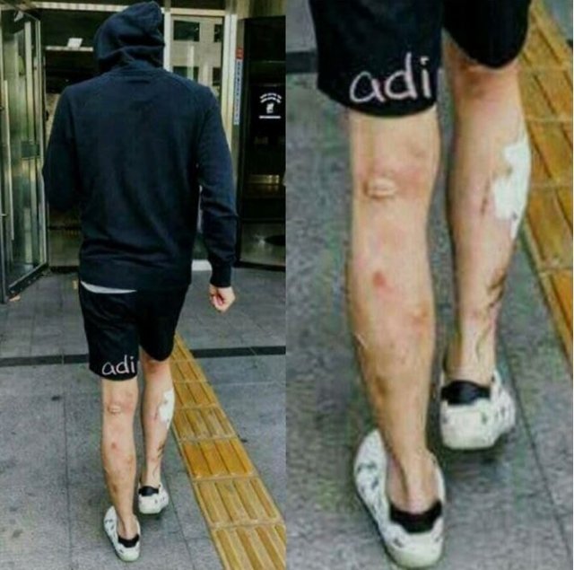  박유천 다리 상처 ‘메스버그 현상’ ?… 심증 뿐, 단정 못 해