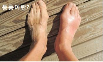  통풍이란? 무엇인가