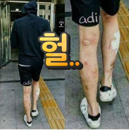  박유천 다리..상처자세히보니 대박,상처이유?필로폰부작용 메스버그현상이란?