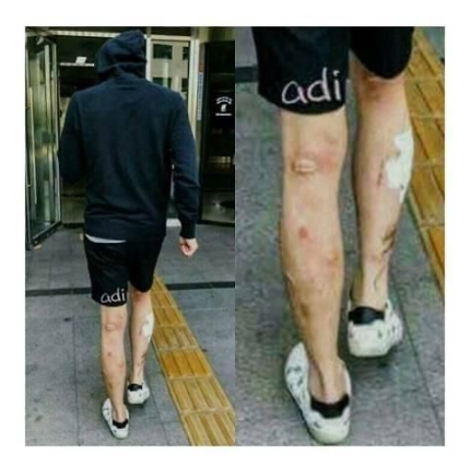박유천 다리 상처는 마약 후유증? '메스버그' 박유천 다리 상처는 마약 후유증? '메스버그'