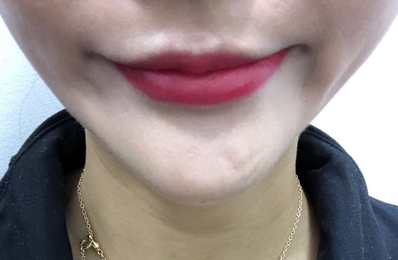 자갈턱 보톡스 부작용 알아보고 하세요! 꼭이요! : 네이버 블로그