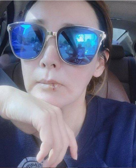  이상아 "98년도에 입술 필러 맞고 20년간 부작용, 불법시술 절대안됨"