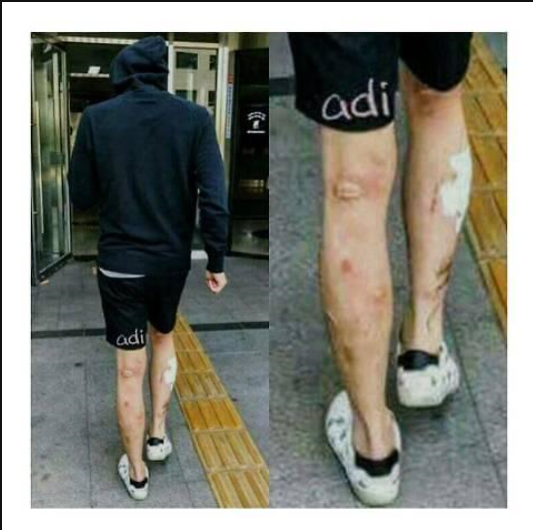  박유천 다리, 필로폰 부작용 아님 알레르기.... 메스버그.....그진실은???