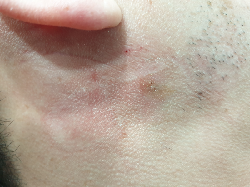 얼굴 혹, 피지종, 표피낭종 수술 핀홀법 : 네이버 블로그 얼굴 혹, 피지종, 표피낭종 수술 핀홀법 : 네이버 블로그
