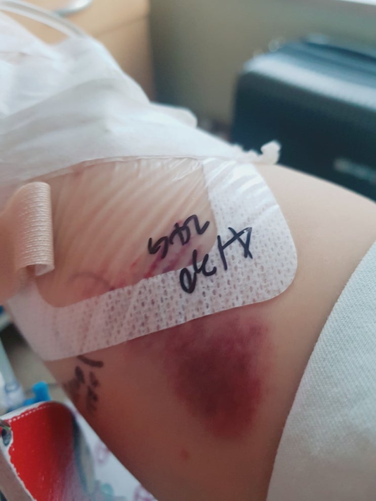  유착성 관절낭염 앤 기도삽관 후 인후통