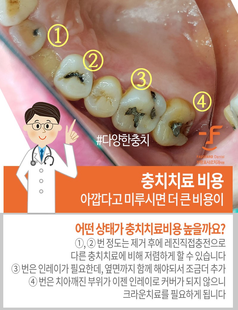 충치 치료 비용, 가격(레진, 인레이, 크라운)