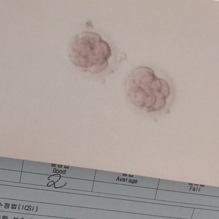  06. 시험관 1차 시술 과정 및 결과이야기 (2018,07,30~08,24)