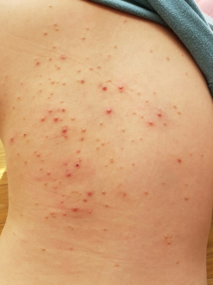 <용인물사마귀> 피부에 생긴 물사마귀 9