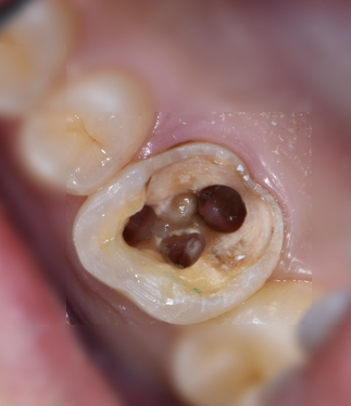 신경치료 중단한 치아의 재치료