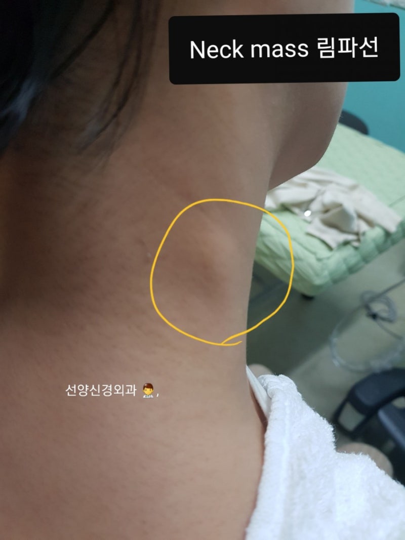 목에 멍울(덩어리,목혹)이 만져저요! : 목 임파선 부종, 임파선염 선양신경외과 : 네이버 블로그 목에 멍울(덩어리,목혹)이 만져저요! : 목 임파선 부종, 임파선염 선양신경외과 : 네이버 블로그