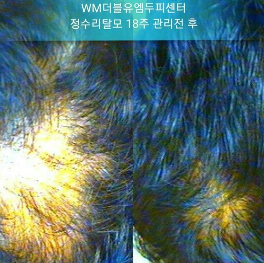  #더블유엠 #두피관리 전후비교 사진!!!