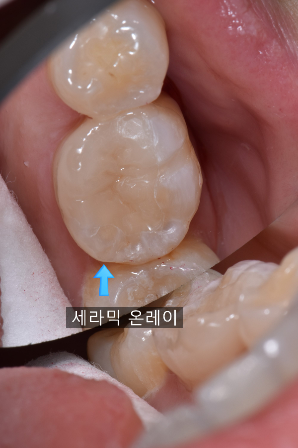  충치치료 세라믹 온레이(예술과 과학의 결합)