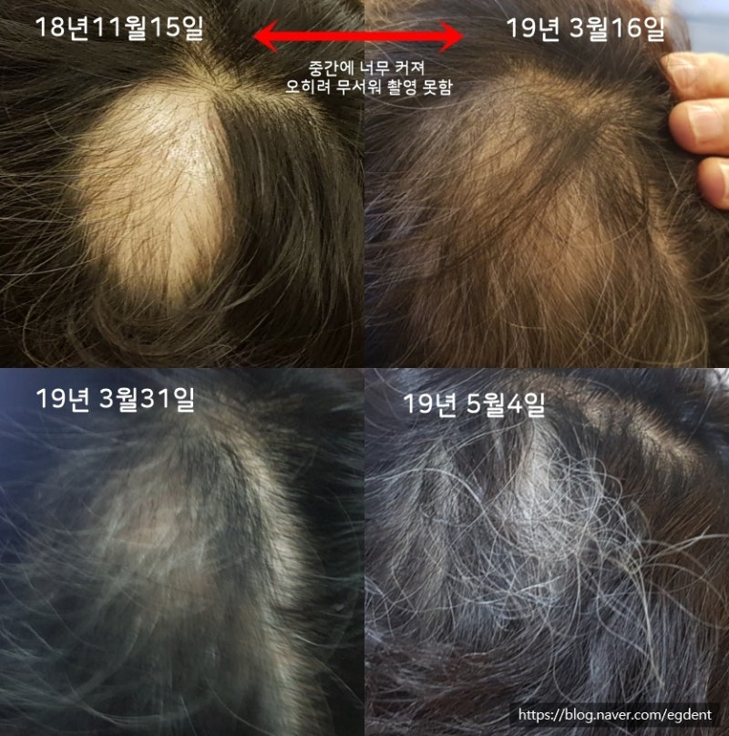 [원형탈모] 흔한 질문: 스트레스 관련성, 주의음식, 재발시 대책, 원형탈모 후 흰머리, 모자·가발 영향, 어린이탈모, 자연치유·회복, 검은콩의 영향