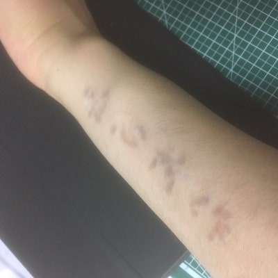 문신제거 홍대연남동피부과 9회 진행 2