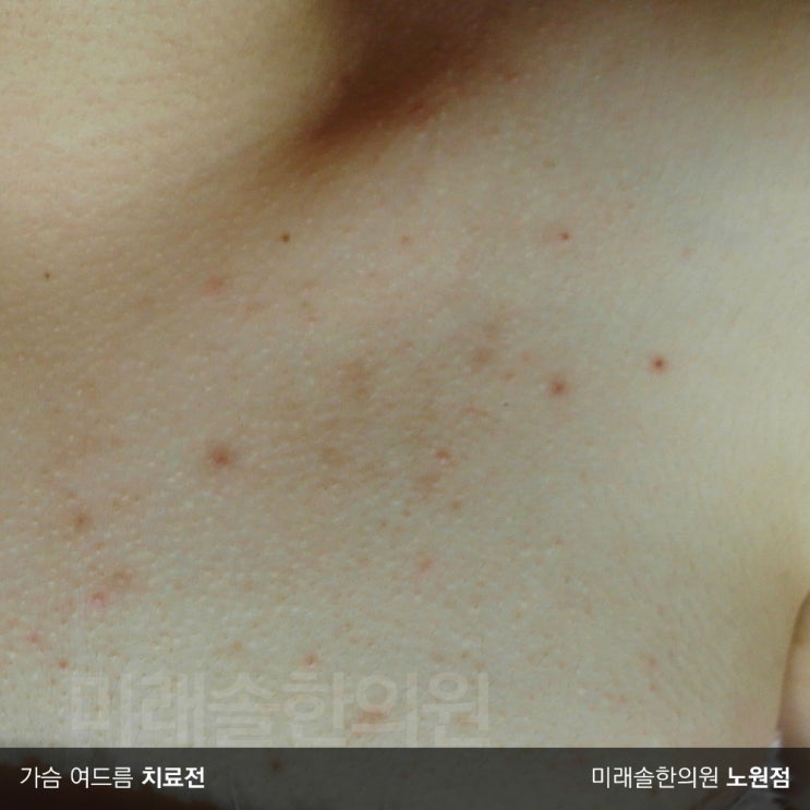  가슴여드름 민망함을 무릅쓰고