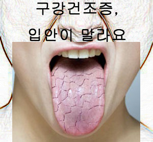 [진주치과/진주보험임플란트]구강건조증, 입안이 마르는 것 같아요