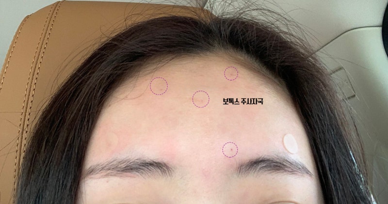 이마 필러 부작용, 시술 시 꼭 고려해야 할 사항은? 11