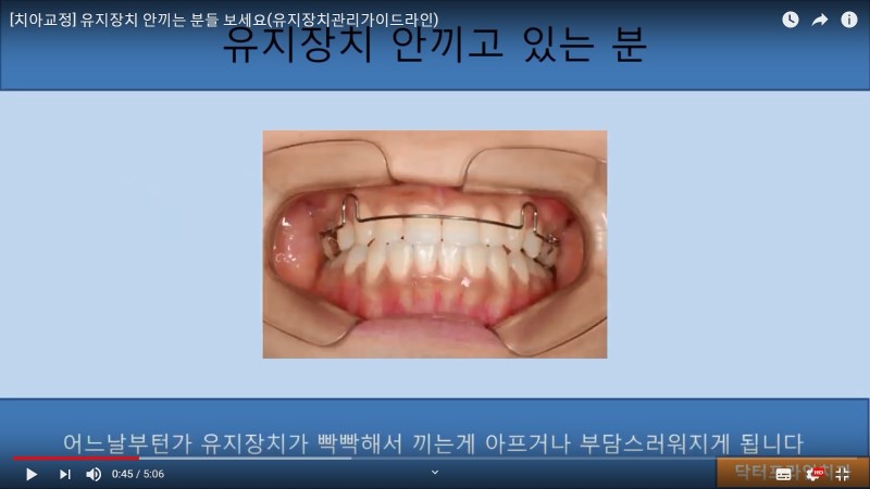 치아교정] 유지장치 안끼고 있는 분들은 꼭 보세요!! : 네이버 블로그