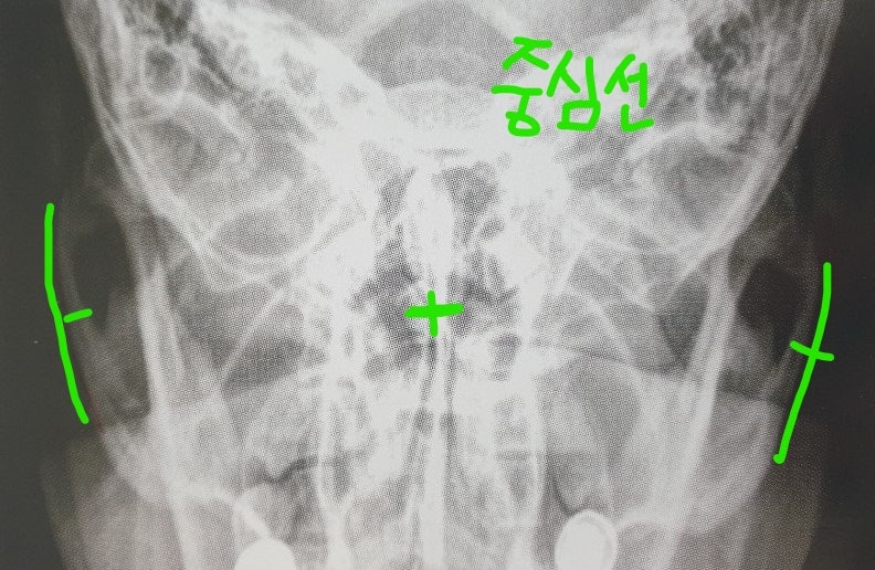zygomatic arch AP axial projection = 변형 Towne법 : 네이버 블로그