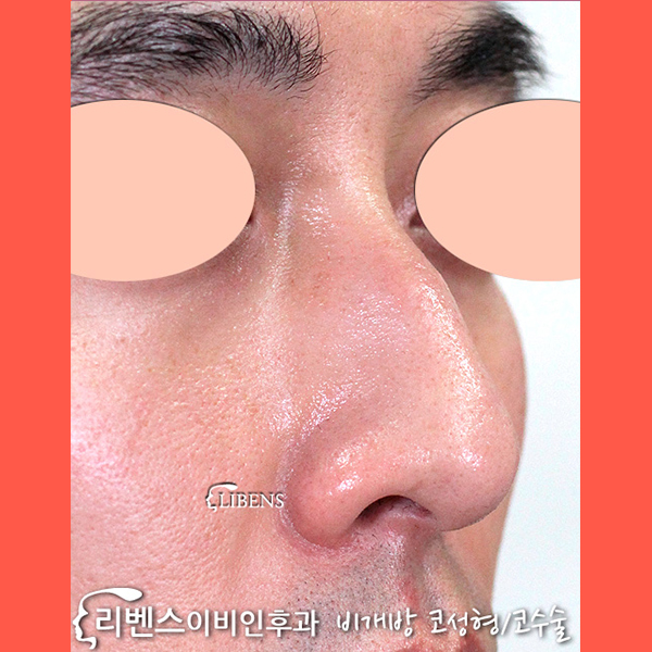  이비인후과코수술, 무보형물을 통해 자연스럽게 아름다워지세요!