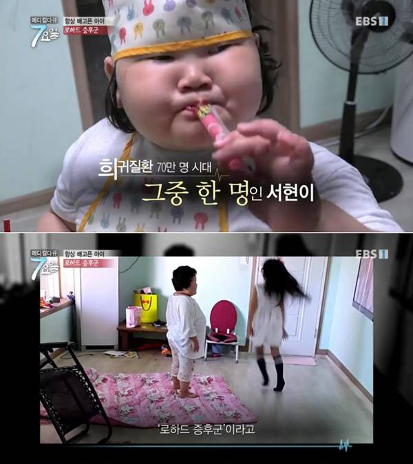  항상 배고픈 아이 '로하드 증후군'…치료법 없어 "성인되기 전 사망"