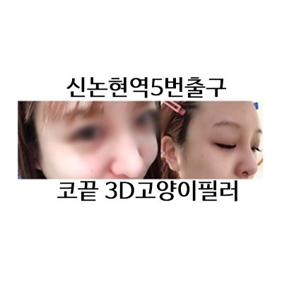  고양이필러 신논현역 5번출구 수술없이 코끝올림 필러전문병원