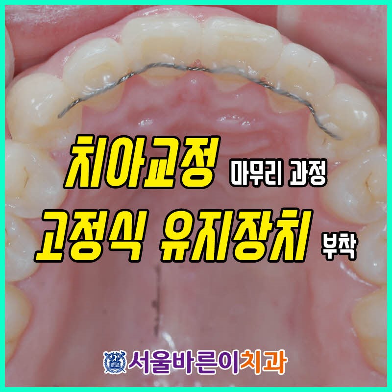 치아교정 마무리 과정 고정식 유지장치 부착 : 네이버 블로그