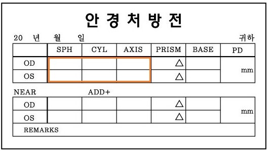 근시는 라식 후 15년 후에 악화되었습니다. 안과진단폼외 안경 도수처방 가격!의정부안경대장