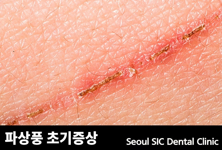 파상풍 초기증상 가볍게 넘기지 마세요 : 네이버 블로그