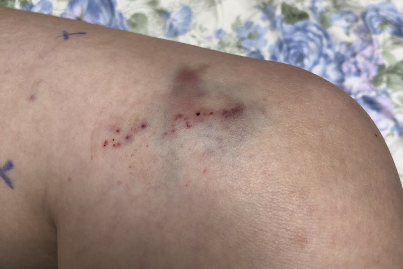 무릎 부상 후 무릎 연골 MRI 촬영