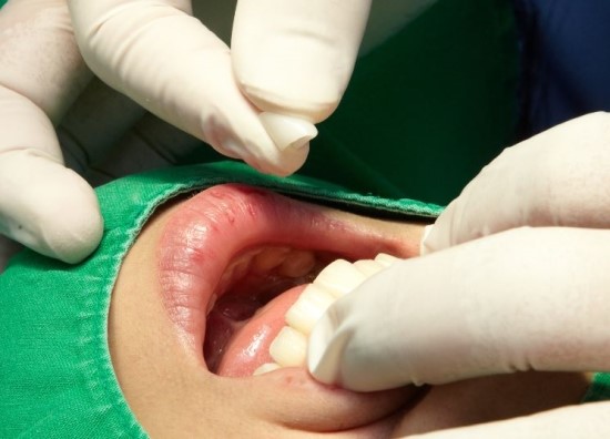 앞니성형으로 치아가 불규칙한 부분을 치료 받을 수 있습니다.
