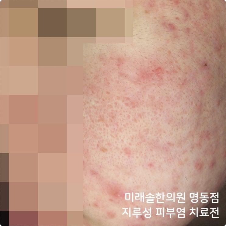  지루피부염 막막하게 다가와서