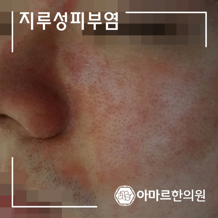 얼굴 가려움증, 꾸준함을 무기로 홈케어 2