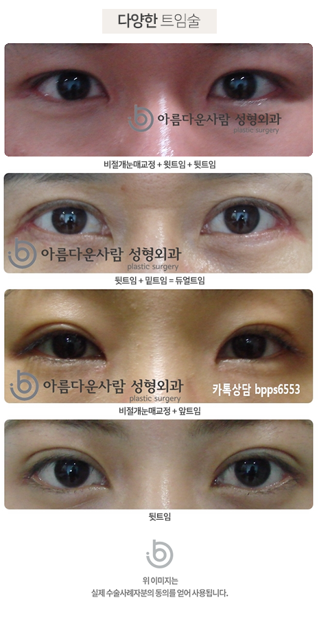 3분유착 이중절개 뒤트임 밑트임 리뷰(듀얼 슬릿 리뷰) 3