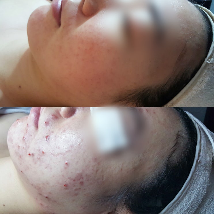  제주시 이도 울긋불긋 여드름관리 13%할인쿠폰!