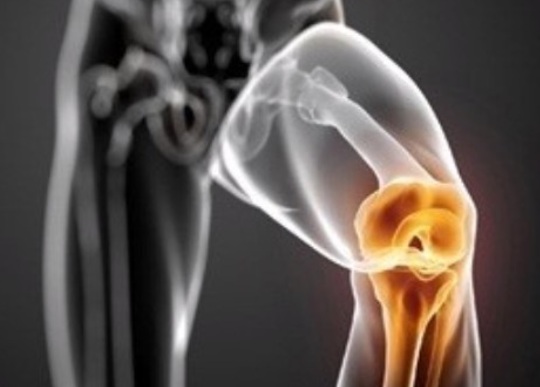 무릎 관절염의 주요 증상 및 예방 습관과 관절에 좋은 음식