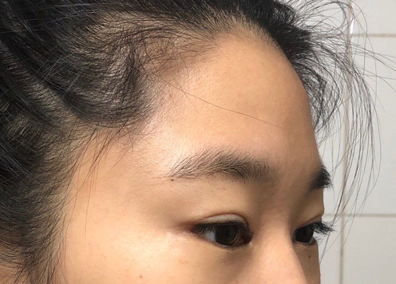 이마필러(채움필러) 시술당일~일주일 후기 내돈 : 네이버 블로그