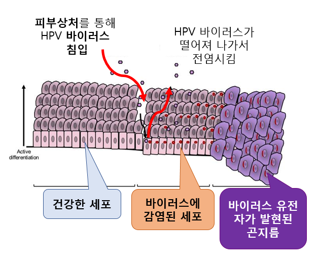  항문 곤지름의 원인