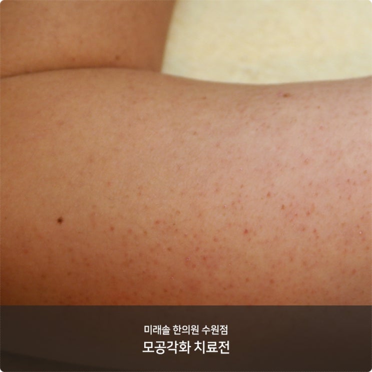  닭살피부 나도 모르게 올라와