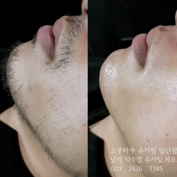  일산왁싱 / 일산 남자 턱수염 왁싱 / 슈가링