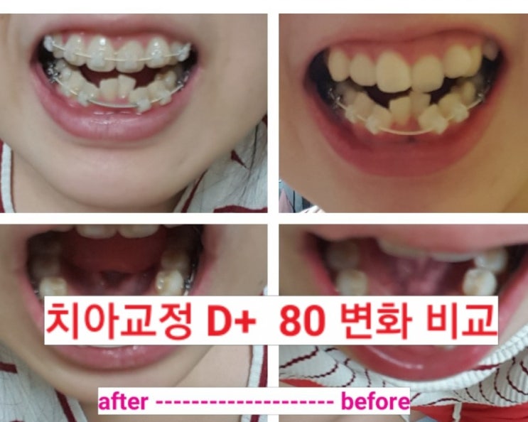  [d+80교정일기] 치아교정 비포 애프터 변화 비교