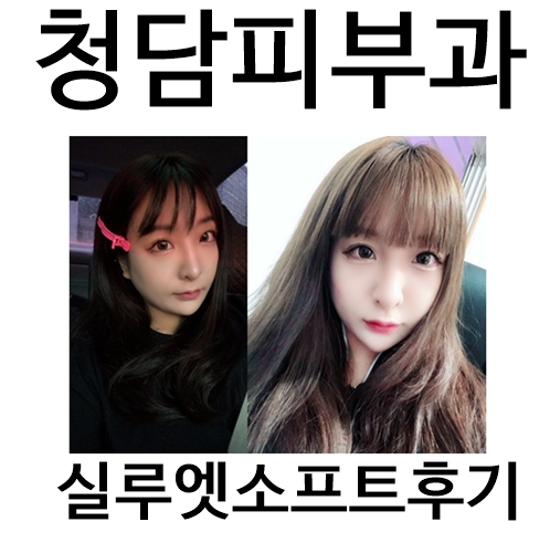  청담피부과 에서 실루엣소프트후기 5G리프팅으로 V라인부터 팔자주름까지 완벽 관리