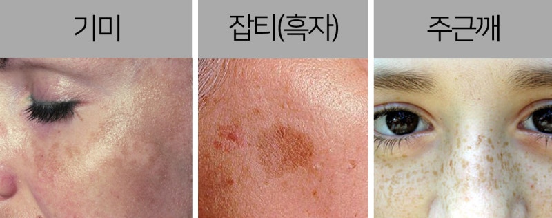 기미 치료 레이저 토닝 꼭 받아야 하나.