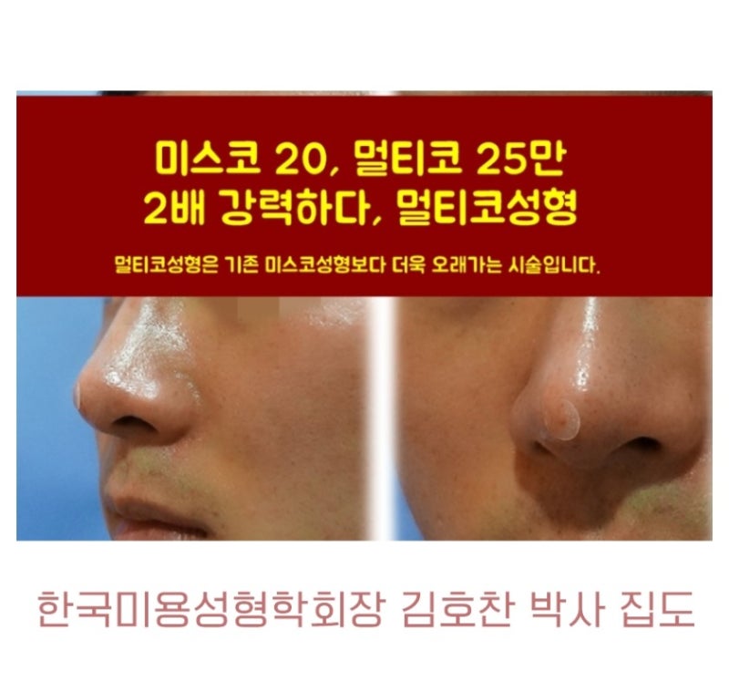 남성을 위한 코성형 리뷰 – 코성형 비용 vs. 코축소 전후 3