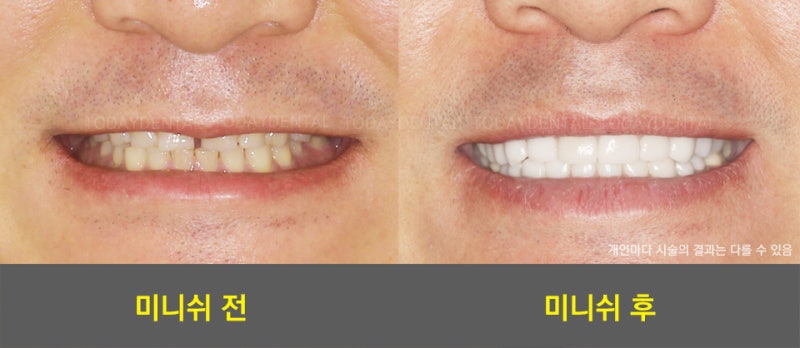 앞니 라미네이트 / 연예인 치아성형 8