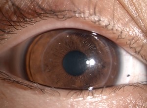 공막렌즈의 구조 및 적용 질환 : 네이버 블로그