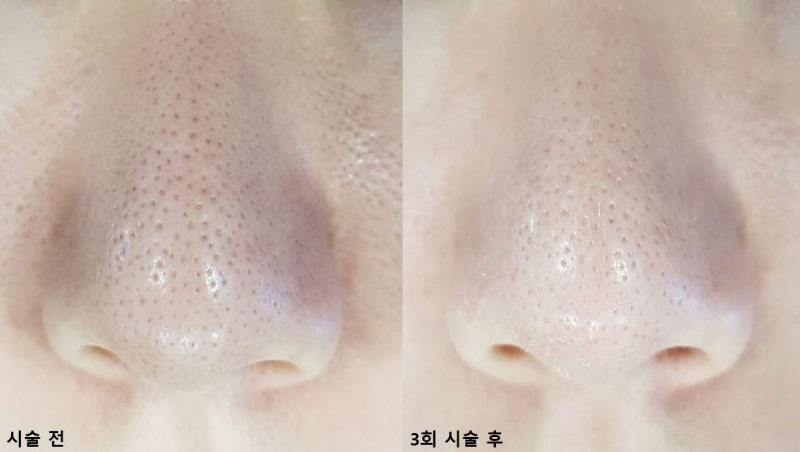 코모공케어 팩트체크와 성공담 4
